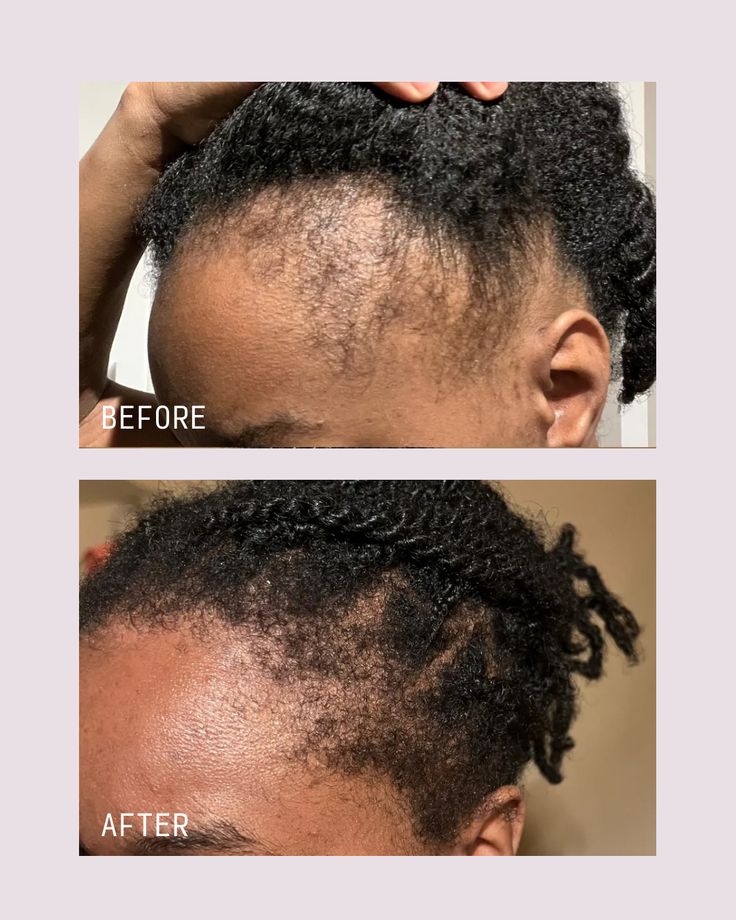 Scalp Stimulator Hair Growth Oil