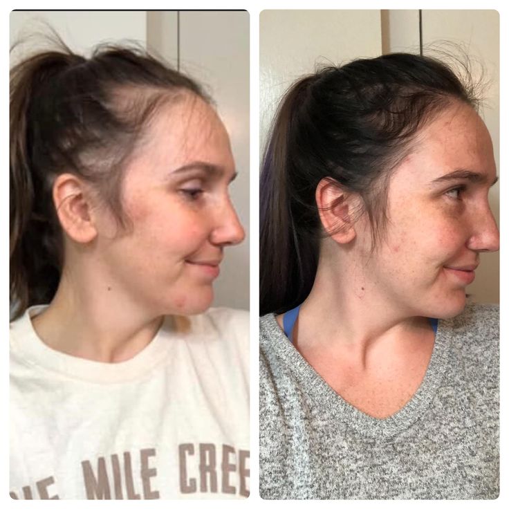 Scalp Stimulator Hair Growth Oil